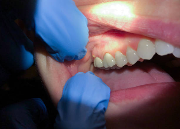 Best Emergency Dentist for Lost Fillings or Crowns in Hebron, OH